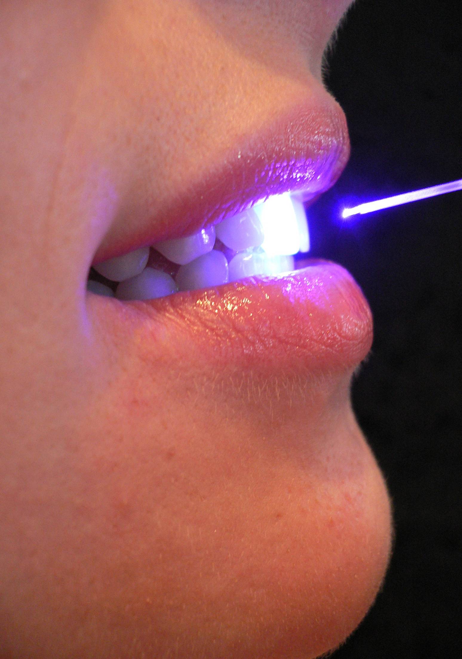 laser_dental